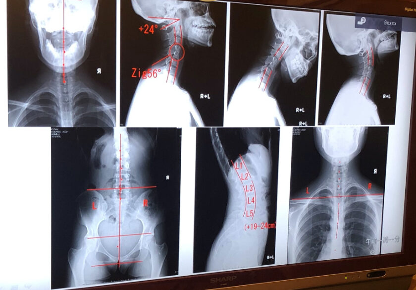 レントゲン分析にこだわった骨格矯正治療 - 大阪府堺市のカイロ 